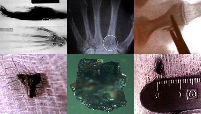 Implantes extraterrestres: ¿Prueba definitiva de las abducciones?